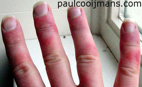 Chilblains - Pictures, Causes, Symptoms, Prognosis and ...