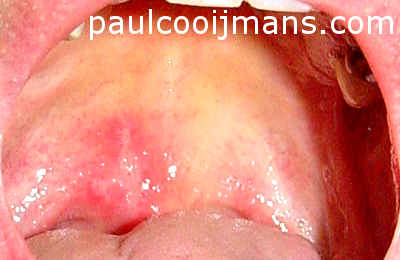 Mouth ulcer in the back of the ceiling of the mouth on the right side (for the viewer left)