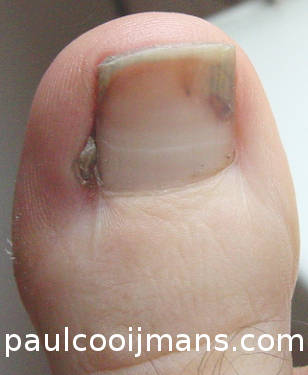 Undergoing an ingrown toenail operation